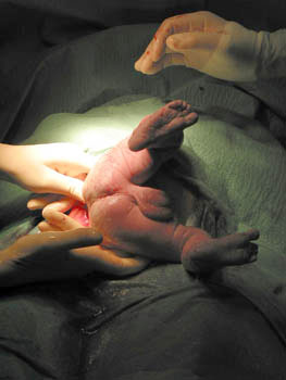 Tipos de parto - La cesárea
