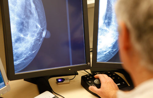 Un estudi aporta noves dades sobre la relació entre alta densitat mamària i el risc de càncer de mama