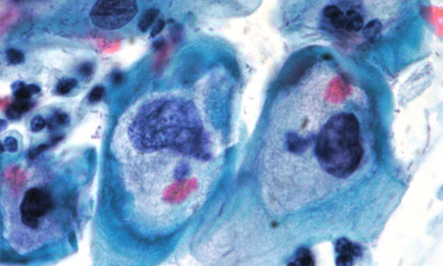 Imatge citològica de cèl·lules infectades per VPH