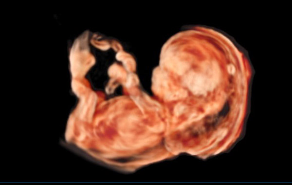 La Fundació Dexeus Dona premia el Prof. Kypros Nicolaides