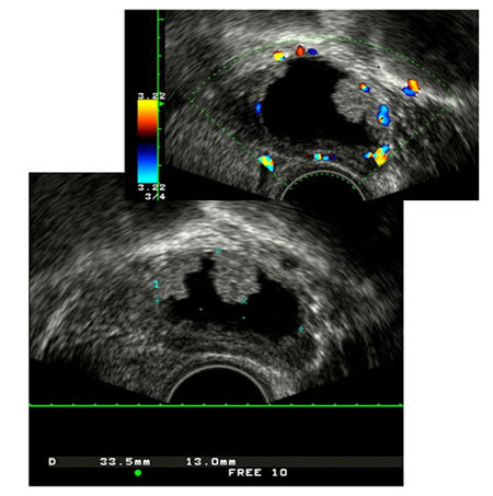 Cáncer de ovario detectado mediante ecografía transvaginal en un programa de screening
