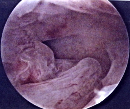 Visión de hipertrofia uterina por histeroscopia