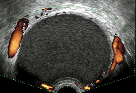 Imatge ecogràfica d'un endometrioma