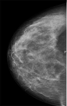 Visión de una Mamografía