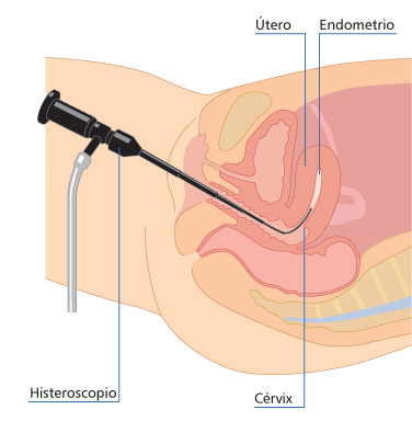 Técnica de realización de la Histeroscopia