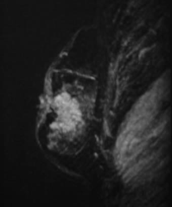 Tumor mamario que provoca retracción de la piel y del pezón, con engrosamiento cutáneo asociado