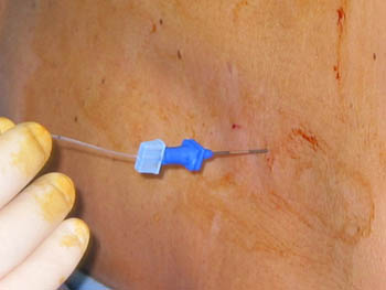 Epidural - Se infiltra anestésico local y después se localiza el espacio epidural y se deja un tubito fino, “catéter”