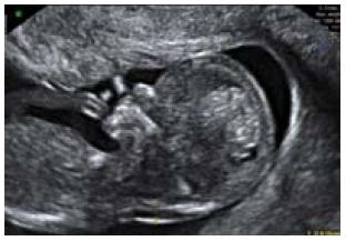 Diagnòstic prenatal i medicina fetal - Tècniques de cribatge