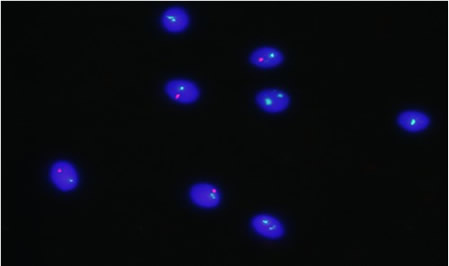FISH de espermatozoides. Cromosoma X (verde), Cromosoma Y (rojo) y Cromosoma 18 (azul)