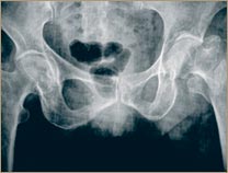 Osteoporosi - Maluc