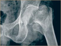 Osteoporosi - Fèmur