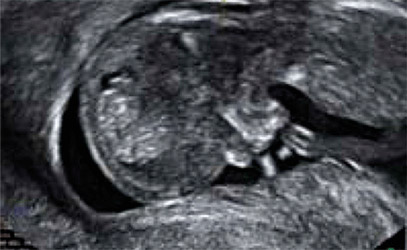 Diagnòstic prenatal molecular (Array CGH) - Resultats