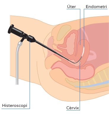 Histeroscòpia - Com es realitza