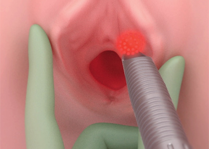 Làser de recuperació funcional - Tractaments