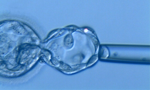 DGP - Biòpsia embrionària realitzada en estadi de blastocist